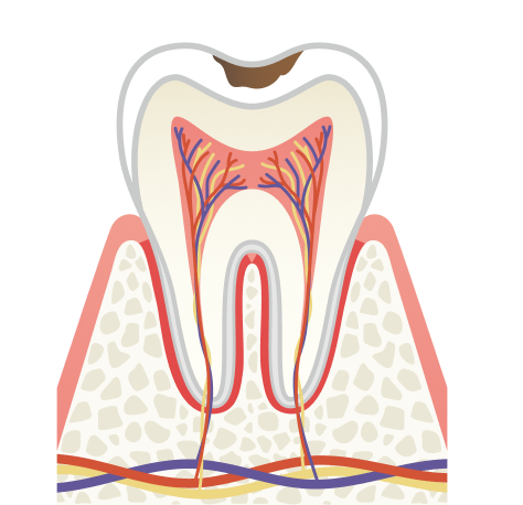 治療内容 C1 エナメル質の虫歯