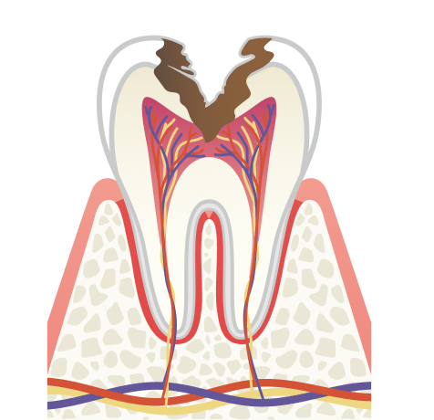 治療内容 C3 神経の虫歯