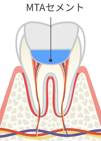 自費診療 神経を守るMTA断随治療（歯髄保存治療）